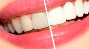 اكتشف الوصفات الطبيعية لتبييض الأسنان والحصول على ابتسامة مشرقة!