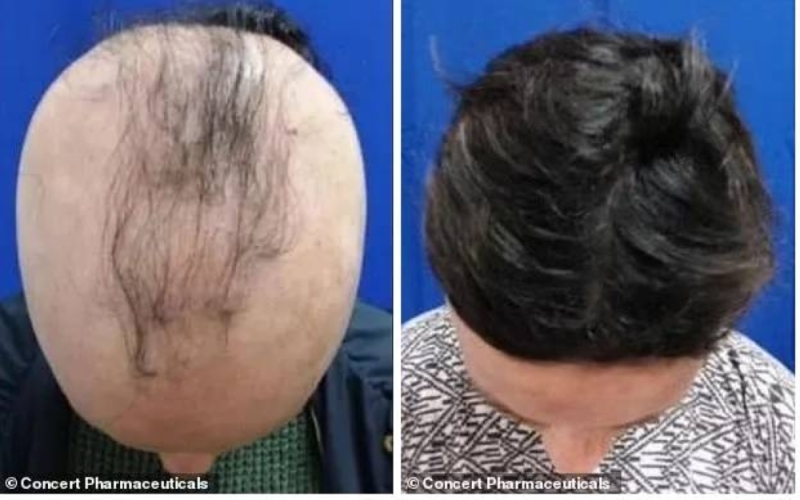  اكتشاف دواء جديد لعلاج الصلع يعيد نمو شعر الرأس بالكامل خلال 6 أشهر 