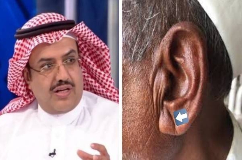 طبيب سعودي يكشف حقيقة علاقة تضخم "شحمة الأذن"والإصابة بجلطات القلب