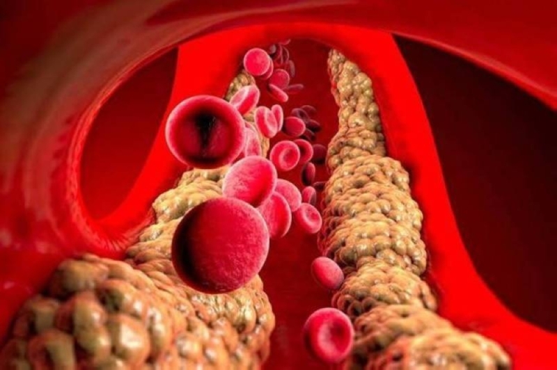الكشف عن 3 طرق سحرية لتنظيف الشرايين والأوعية الدموية من الدهون والكوليسترول الضار
