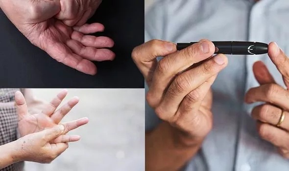 3 علامات في اليدين تحذرك من تلف في الاعصاب وارتفاع نسبة السكر في الدم