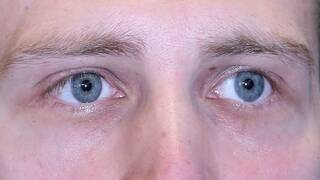 أخصائي أمراض العيون يكشف سبب إصفرار بياض العين