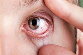 سرطان العين.. 5 أعراض خطيرة تشير للإصابة به| تعرف عليها