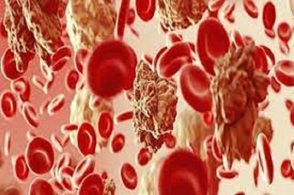 ثلاثة أعراض لسرطان الدم غالبا ما يتجاهلها الناس وقد تكون قاتلة..تعرفوا عليها !