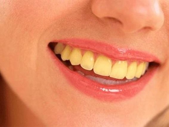 طرق طبيعية للتخلص من الجير المتراكم على الأسنان واصفرارها